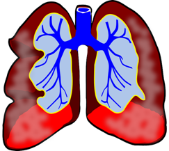 bronquitis enfermedad